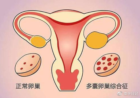 什么是多囊卵巢综合征?怎么分辨自己是否多囊卵巢?