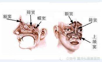 重庆弘医堂医院讲解:鼻窦炎会引发哪些危害|并发症|鼻窦炎|重庆弘医堂
