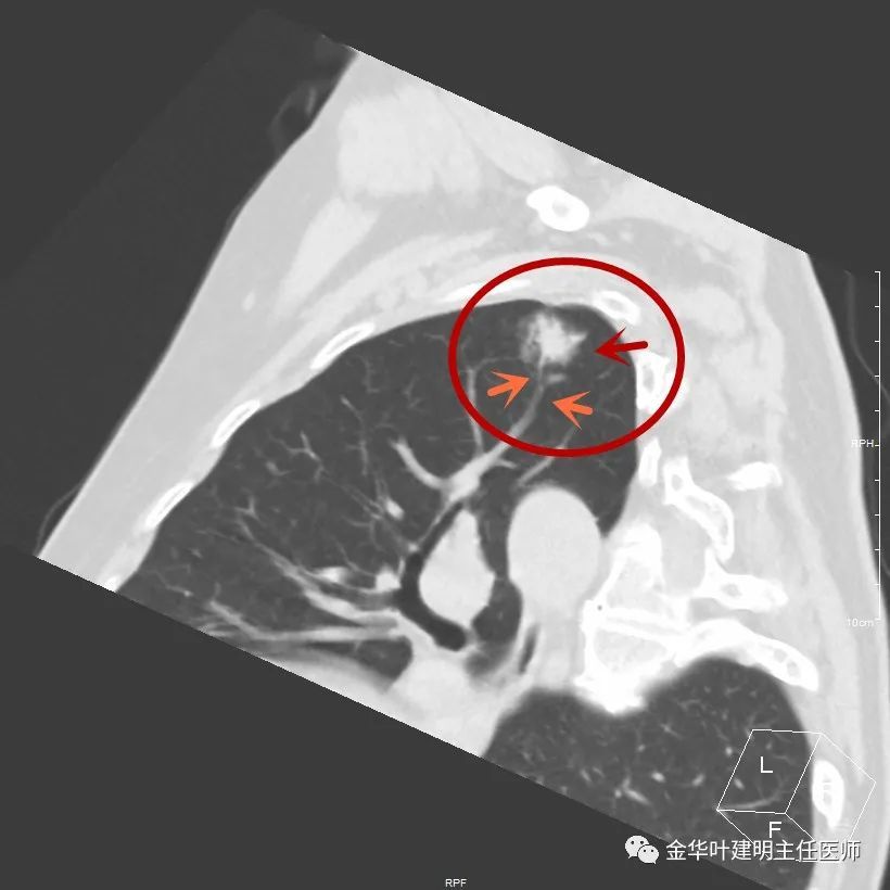 1.18:伴长毛刺又不太密实的结节会是肺癌吗?