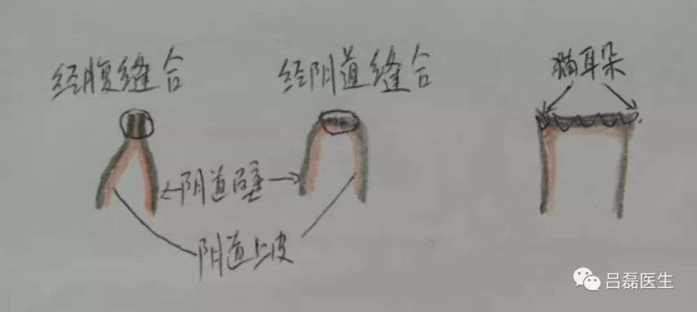 宫颈锥切术后子宫全切,哪种方式更好?