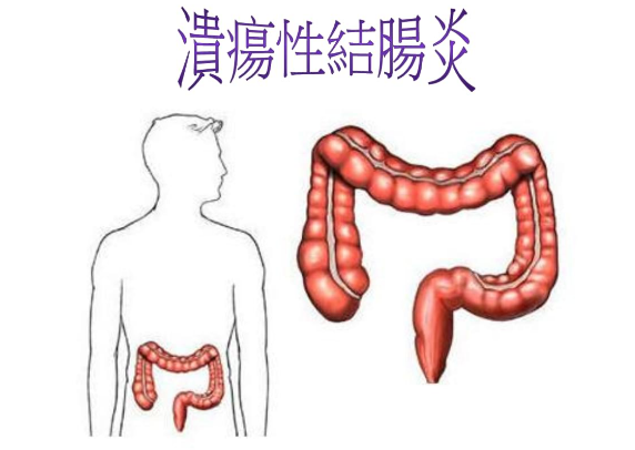 该如何调理溃疡性结肠炎?