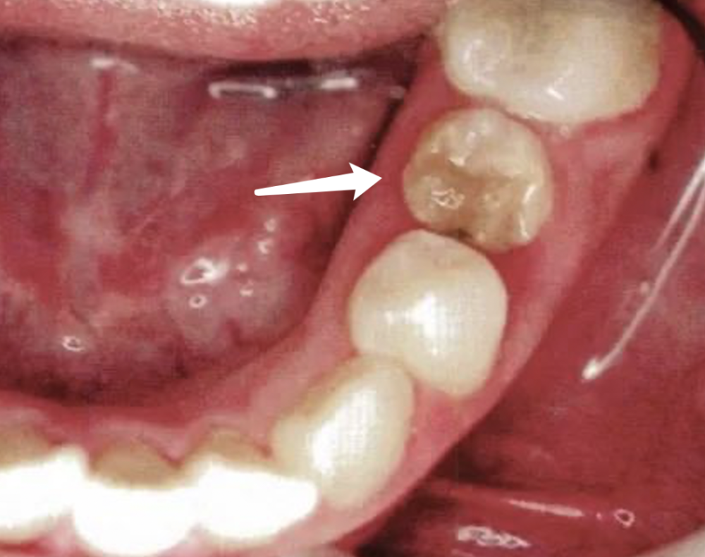带着缺陷萌发出来的恒牙,则有可能变成 特纳牙,也就是牙釉质发展不全