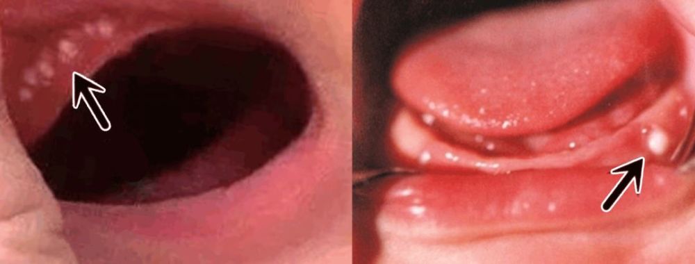 孩子牙龈长包,吃点消炎药就能好吗?