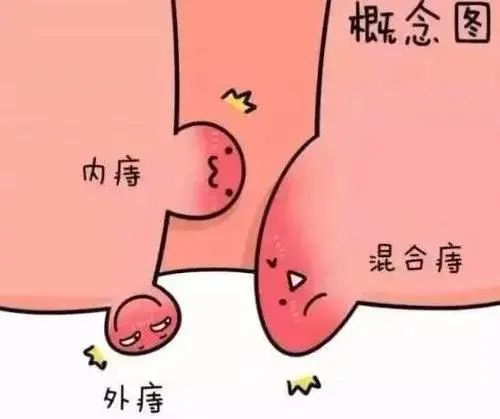 由此可见,只要肛门出现明显的小肉球症状,哪怕它没有任何疼痛不适症状