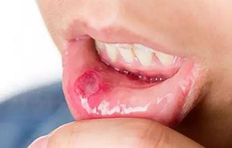 口腔溃疡反反复复担心癌变?警惕这三大特征