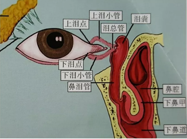 慢性泪囊炎是由于鼻泪管狭窄或者阻塞,导致泪液流通不畅,出现"溢泪"