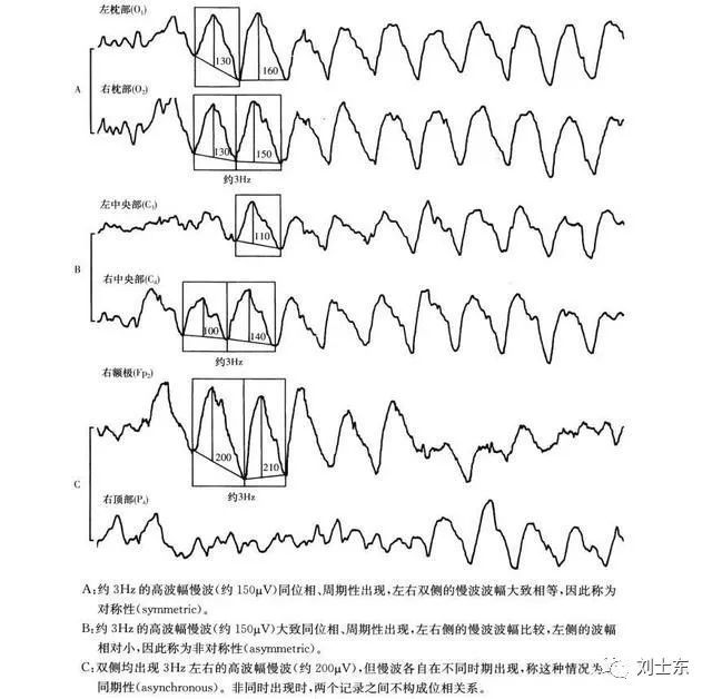 脑电图基础知识科普(简单易懂)