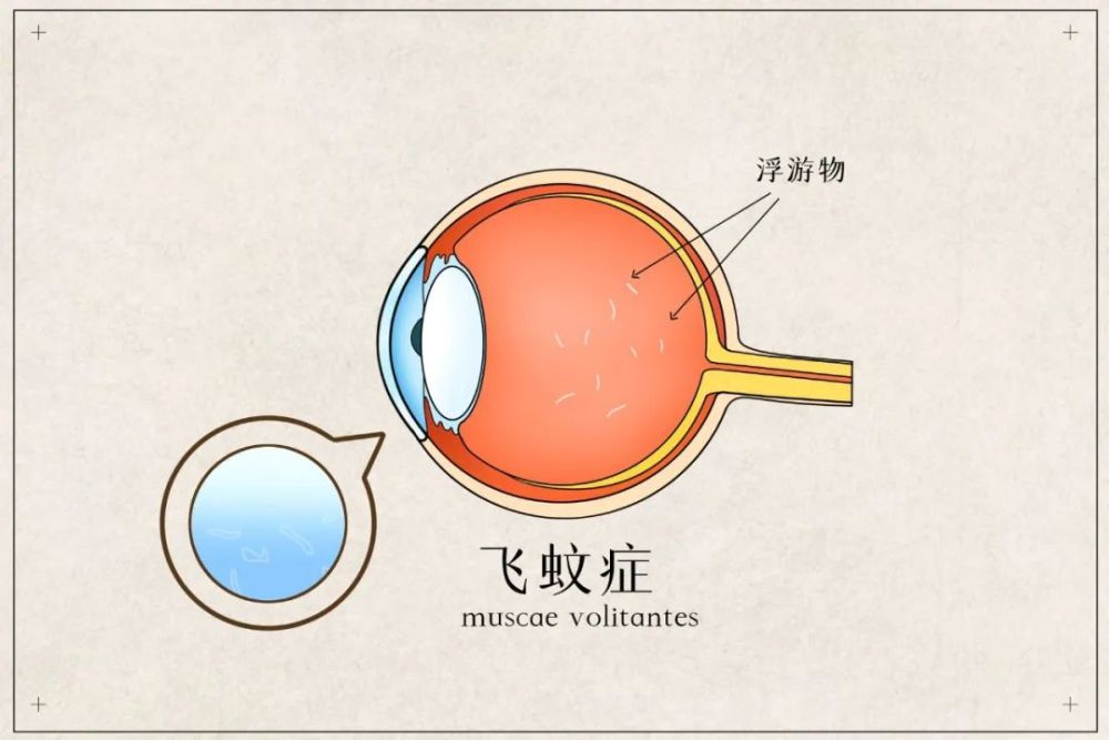 眼睛玻璃体浑浊,看东西模糊,"飞蚊症"该怎么治疗?