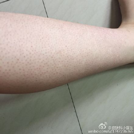 马歇尔怀特综合征