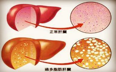 让人少活10年,甚至诱发肝癌的脂肪肝到底应该如何应对?