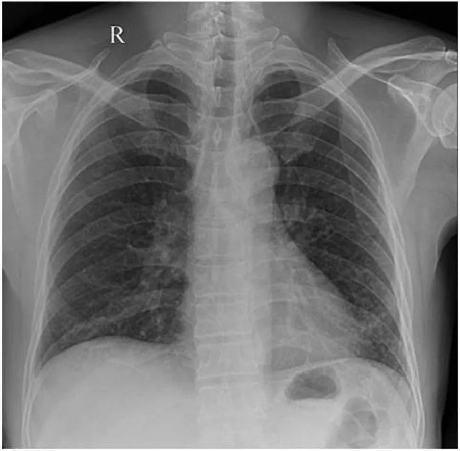 胸片显示左下肺阴影