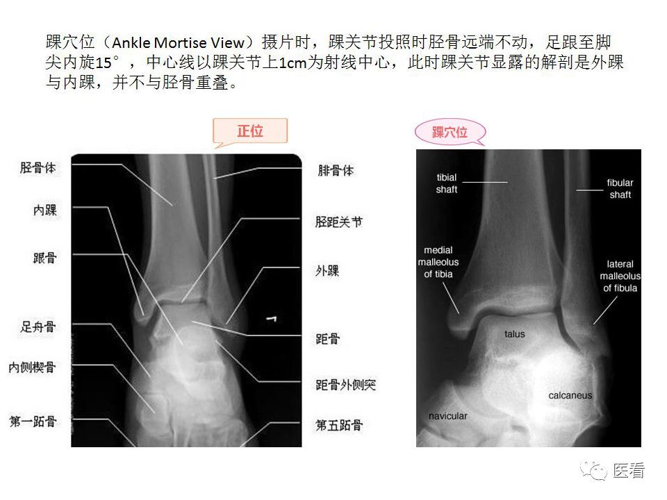 部分x片的测量方法