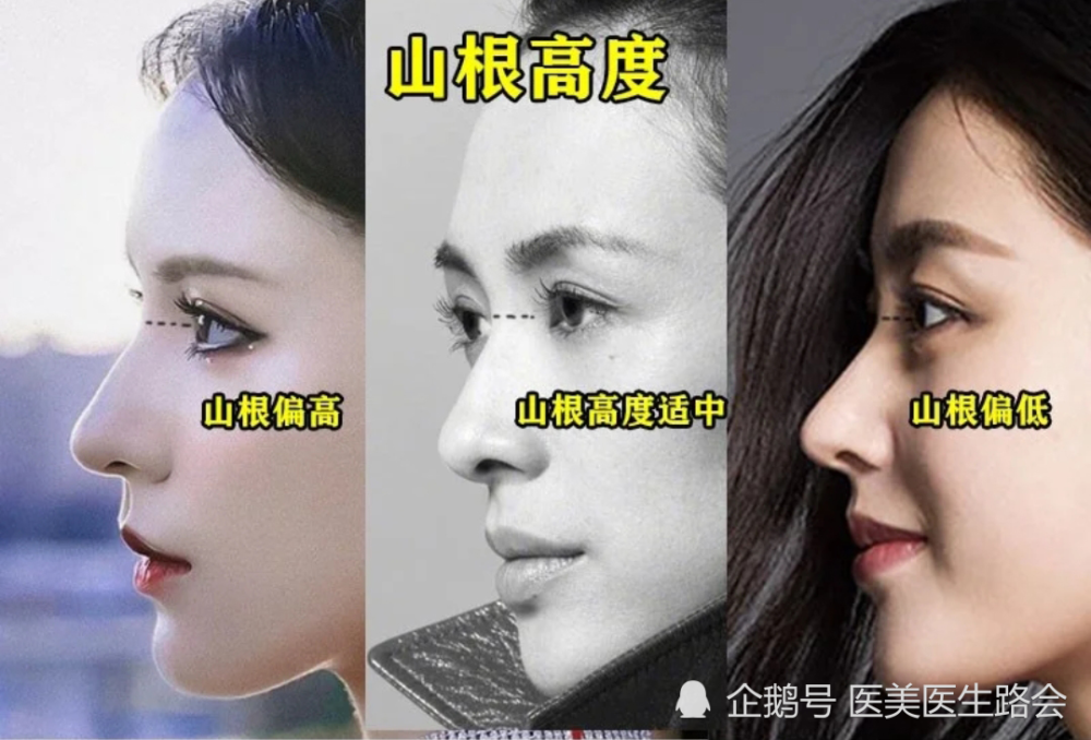 尤其是眉弓,额头很平整的,鼻根就不能垫得太高,否则就成了"通天鼻"