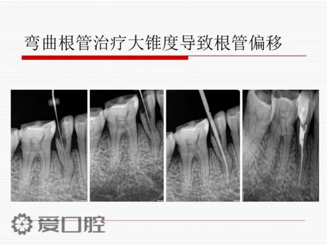前牙前磨牙根管治疗标准化操作浅析