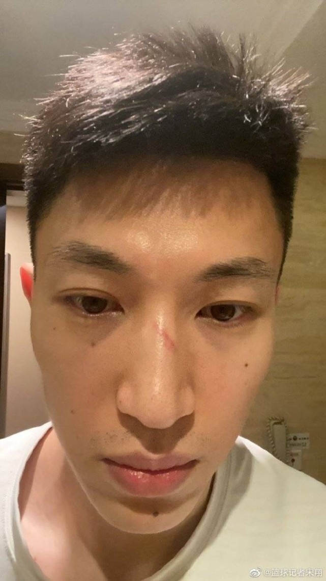 刘晓宇骨折的鼻子又添新伤!此前刚做完鼻骨复位手术
