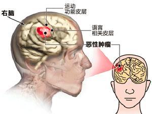 科普啦深入了解脑肿瘤