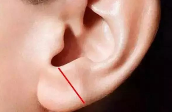 随后这条斜纹被医学界称为"耳褶心征".