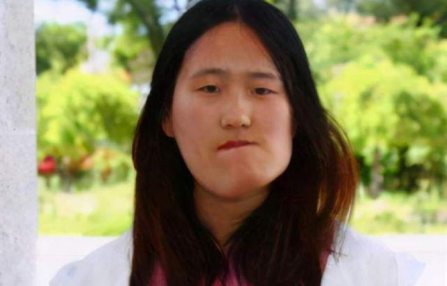 "歪脸女孩"现状如何?整容后成美女,拒绝百万年薪仍当老师