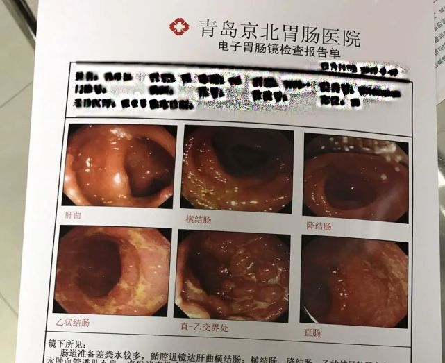 肠镜检查报告如下