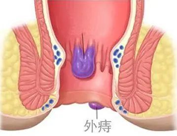 肛门总有坠胀感,但又无便可排?