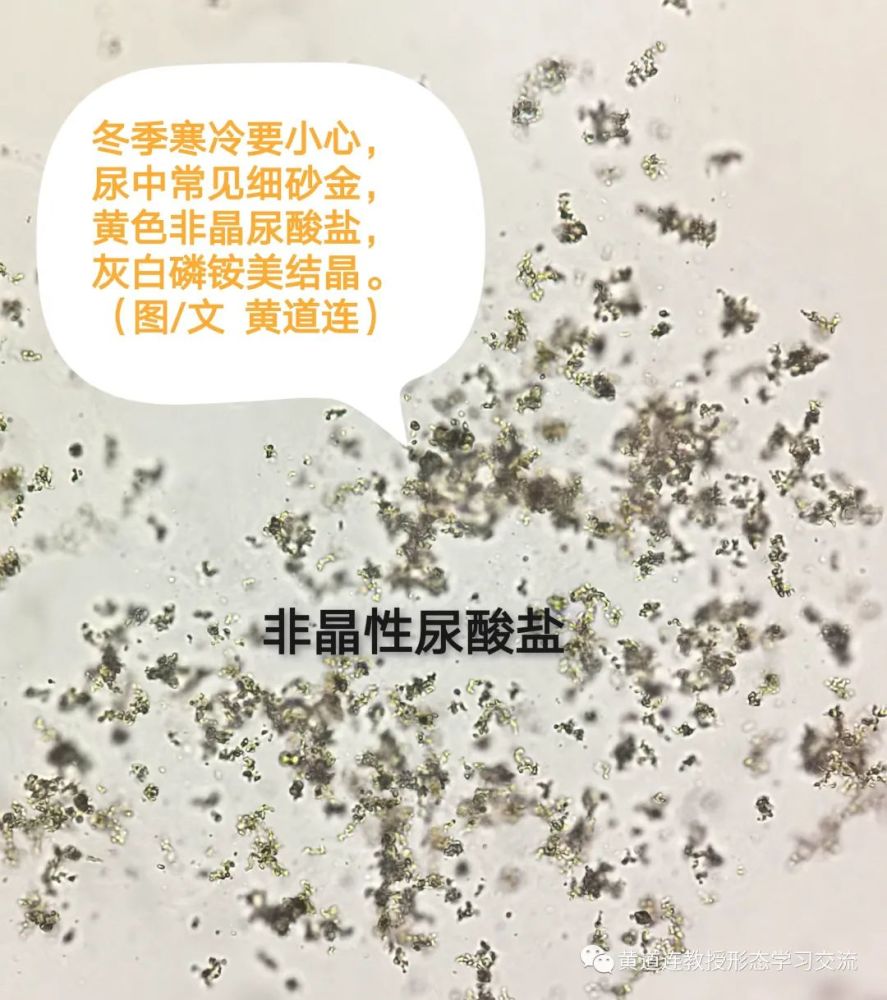 冬季气温较低,喝水也比较少,尿中无机及有机盐(如氯化钠,磷酸盐,尿酸