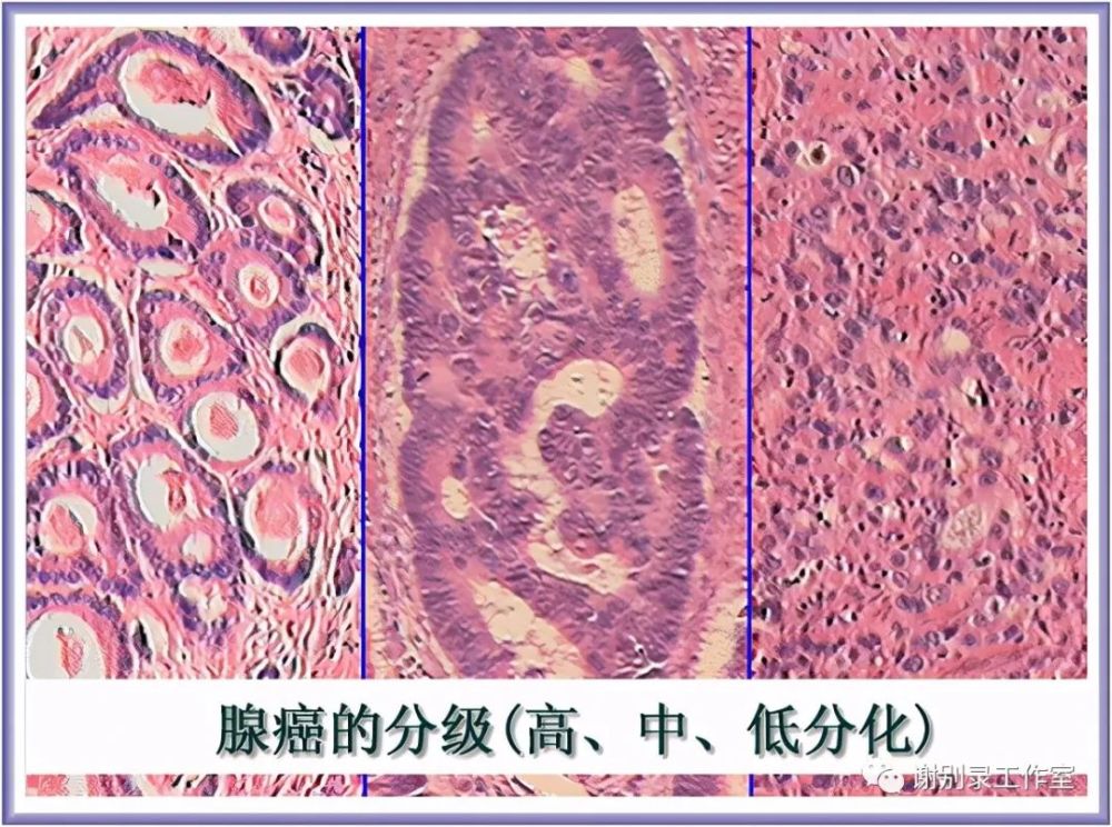 大家可以看到,腺癌的分化程度越高,层次感越清晰.