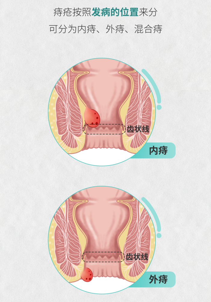 肠画短说:十男九痔,但你真的了解痔疮吗?