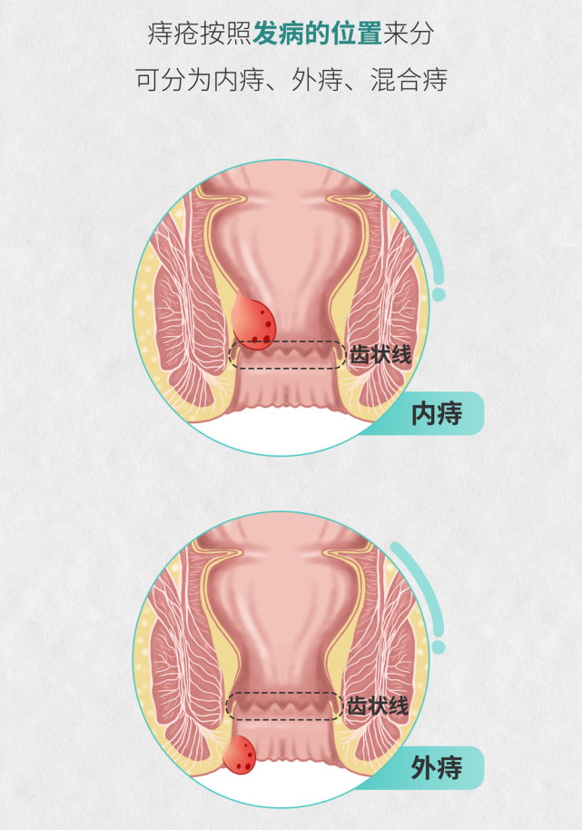 一下生活中非常常见的一种肛肠疾病-痔疮,常言道,十男九痔,十女十痔