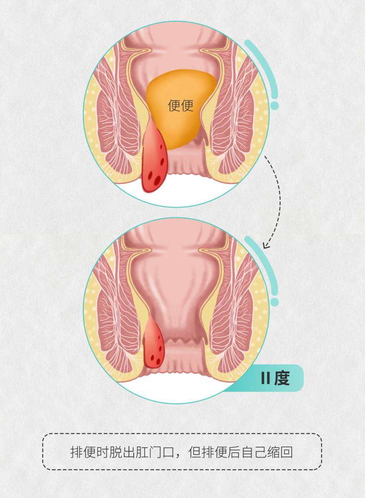 肠画短说:十男九痔,但你真的了解痔疮吗?