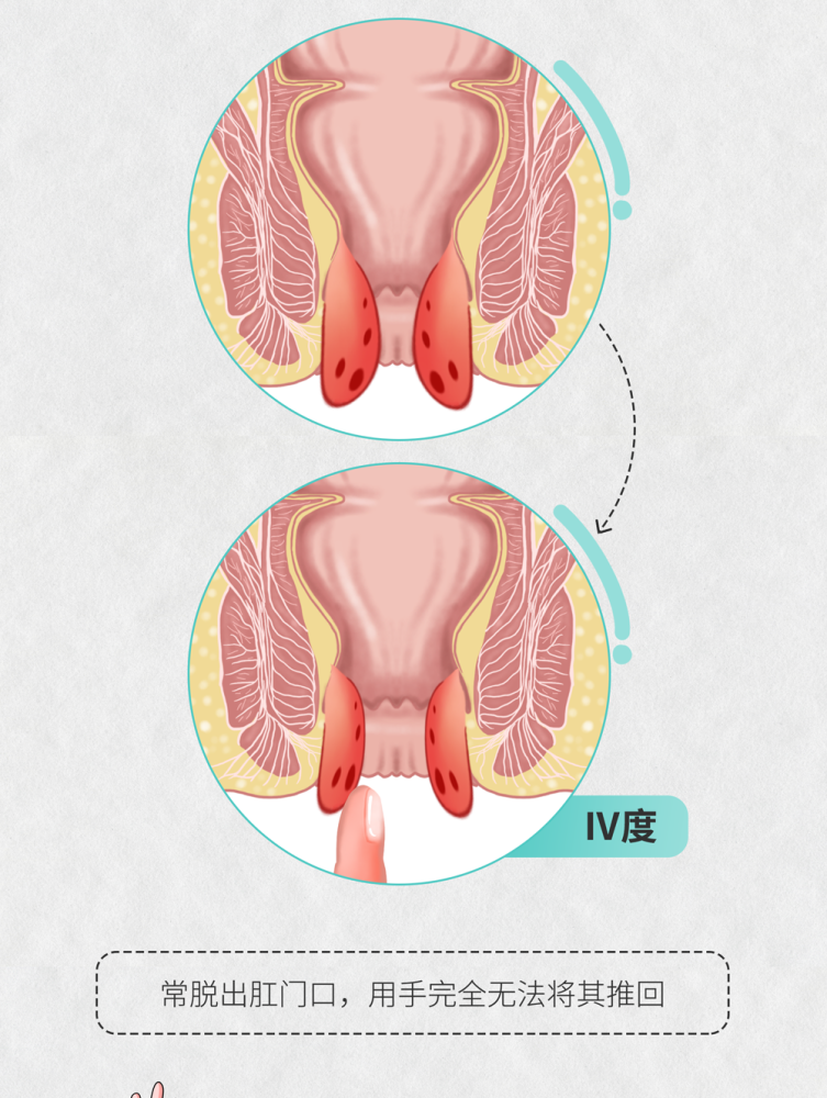 肠画短说:十男九痔,但你真的了解痔疮吗?