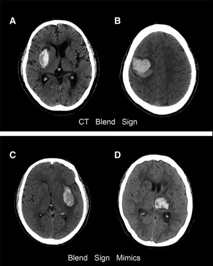 手把手教你怎么判断脑出血血肿扩大影像学征象!