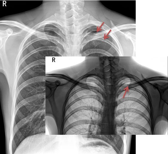 气胸的x线表现,6个病例帮你搞定!