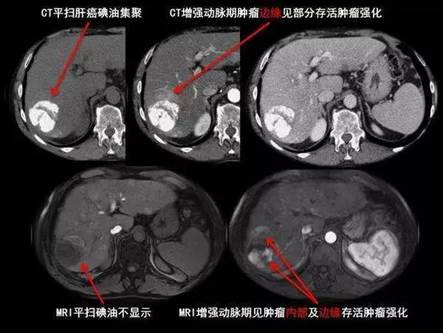 jmt|日本-这些症状容易被我们忽视,如何诊断肝癌?