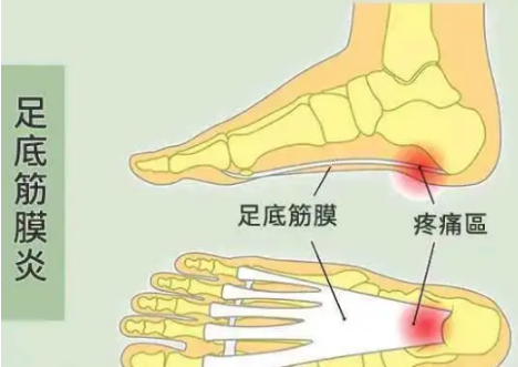 经常足跟疼痛是怎么回事谨防足底筋膜炎