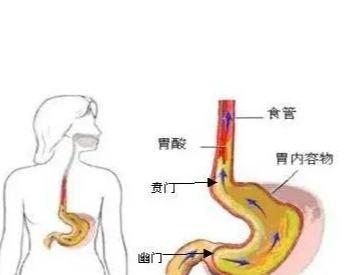 了解食管狭窄的三处位置,采取合适的治疗方法,更好应对食管狭窄