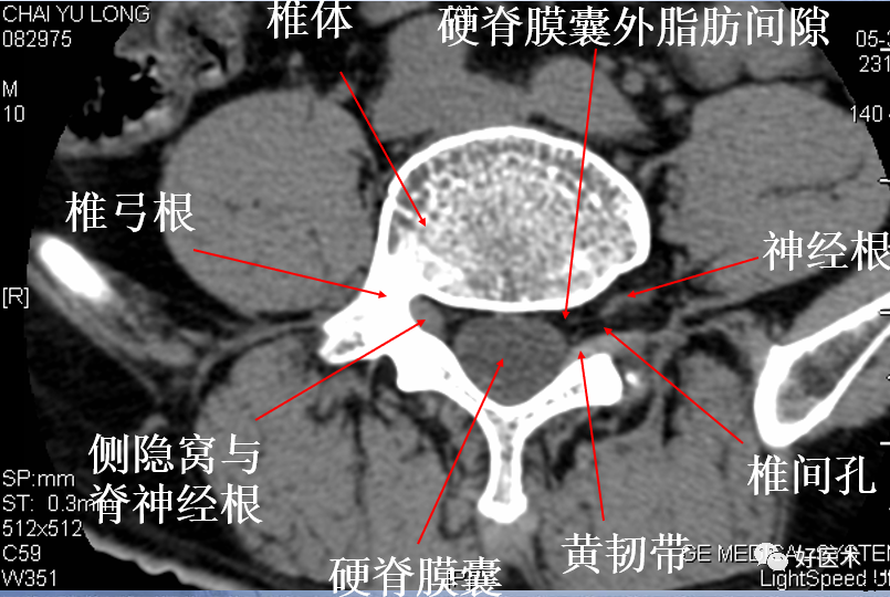 重要发现:这份"无漏洞"的腰部ct为影像科医生敲响警钟!