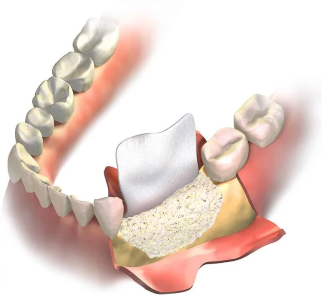 种植牙补骨粉有无痛苦和风险?