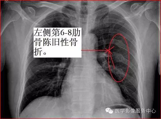 如何看x线片上的肋骨骨折