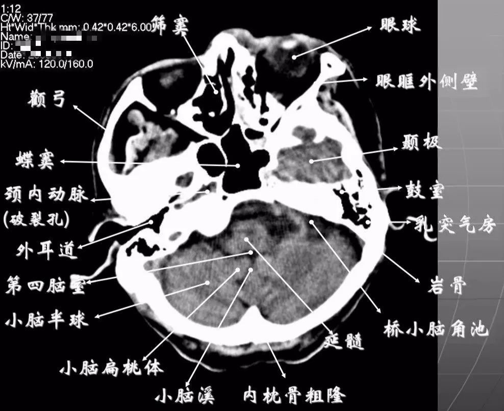 第四脑室:位于颅后窝中线上,后面紧邻小脑蚓部,其两侧为小脑扁桃体.