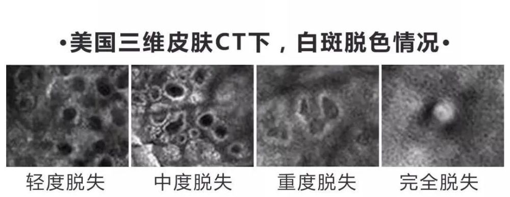 下图为白癜风与无色素痣相鉴别的典型病例.