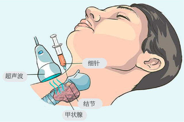 疑似甲状腺癌去体检医生却让患者唱歌这是怎么回事