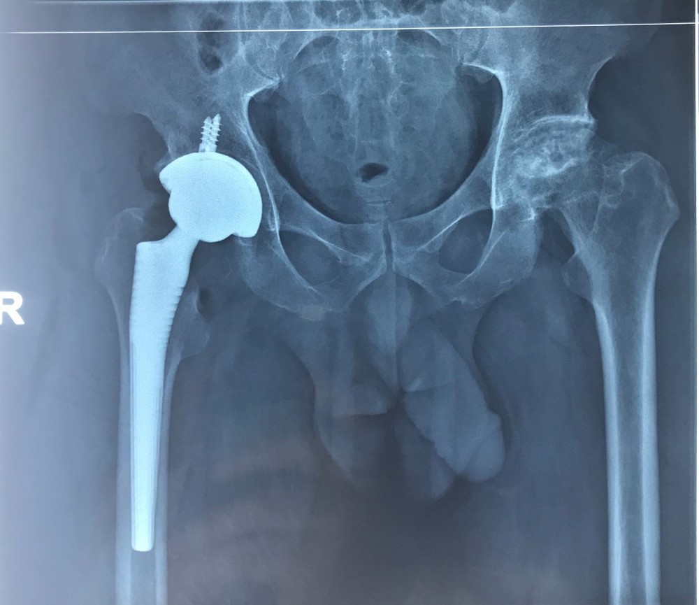 x片检查不仅股骨头塌陷,髋臼也有一些软骨的磨损,关节间隙变窄,髋关节