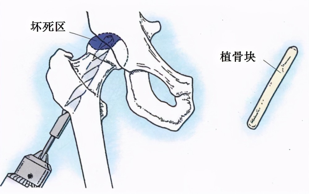 股骨头坏死是如何分期的?哪些患者可以保头?