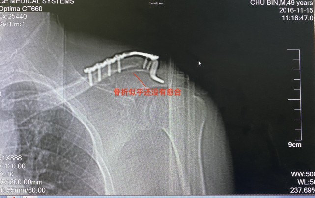 17个月的锁骨骨折,看似没有长好,究竟能不能取钢板?