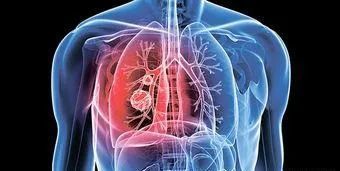 50岁男子戒烟一年后查出肺癌离世,医生:这3处"疼"要当心