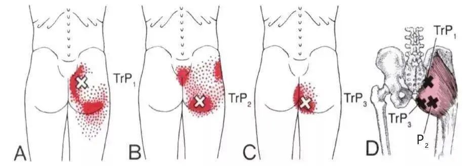 臀大肌激痛点图示