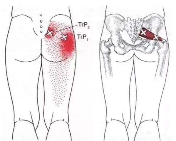 就十分好理解 梨状肌激痛点图示 由此可知,环跳穴关联的浅层的臀大肌