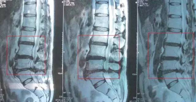 腰椎间盘突出患者,必须知道的两点!