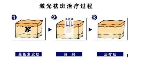 【美丽讲堂】黄褐斑,雀斑,老年斑,炎症色沉 傻傻分不清