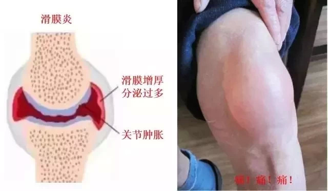 膝关节滑膜炎的症状有哪些